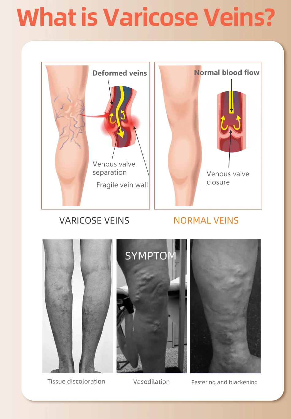 30-40 MmHg กว่าเข่าปิดนิ้วเท้า - Compression Sock Medical บทวิจารณ์และราคา